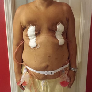 DIEP flap Mell rekonstrukció mastectomia után