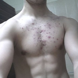 accutane before and after chest