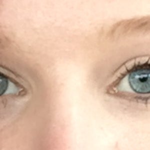 genetic under eye creases