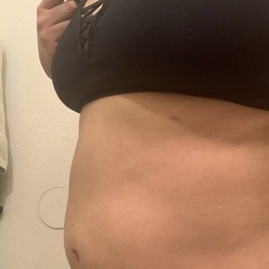 sirve la l-carnitina Fat Dissolving Shots vs Liposuction: Near me Markham Toronto main image 0
