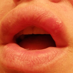 blittle blister on bottom lip from c-pap What Are These Tiny Blisters on my Lip After Augmentation?