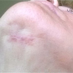 Mottling