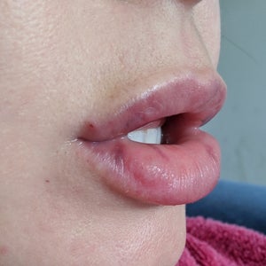 lipo c injections san antonio Lipo C Injections in San Antonio