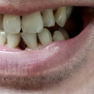 Dental Bridge Reviews Was It Worth It Realself