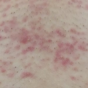 Are these red spots normal after laser hair removal how long do