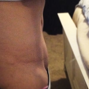 Prominent mons pubis 6-1/2 months after Abdominoplasty. It's the