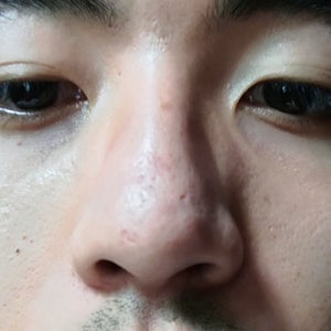 best cream for pitted acne scars
