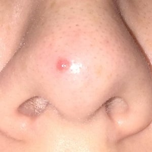 Raised Red Mole On The Tip Of My Nose Can I Get It Removed Without Scarring Photo