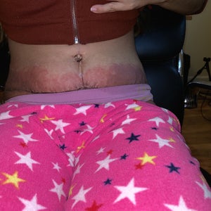 Severe Dermatitis Rash After Tummy Tuck Has Anyone Seen This Before Photo