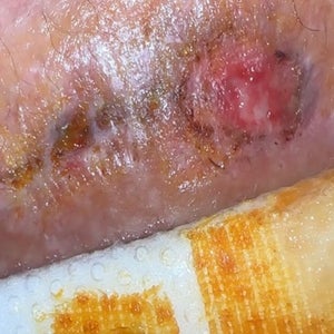 Open wound advice? Do I need to get it stitched again? I am no