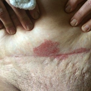 I have excessive skin flap where I had a c-section.This area is
