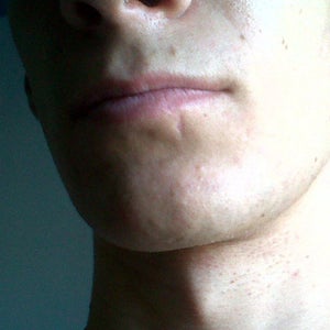 What is the Best Option for the Indented Scar Under my Lip? (photo)