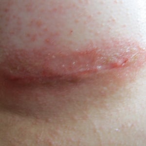 Causes and Remedies For Horrible Rash/ Reaction Post Breast