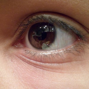 wrinkles under eyes at 15