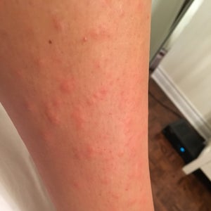 1 day post laser hair removal and experience very itchy red bumps