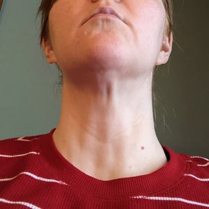 Indentation after chin liposuction - what is it and what can be done to smooth it out? (photos)