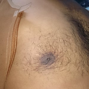 Droopy Nipple Steroid 💉💪Induced Gynecomastia Gland Removal By Dr