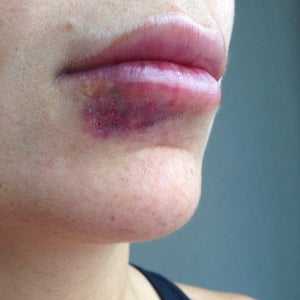 melanotan 2 side effects moles Love Island generation' skin cancer fear