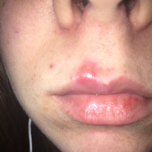 What Do I Do About This Giant Most Likely Acne Bump On My Lip Line Photo