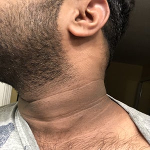 hydroquinone cream for dark neck
