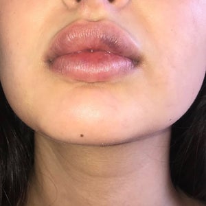 bruising on.lip from c pap Lip filler stages Arnicare Australia How to resolve CPAP mask