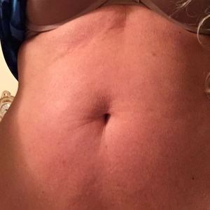 Vaser Liposuction Reviews Was It Worth It Realself Page 39