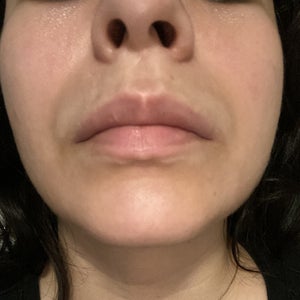 What can I do about my upper lip area Photo