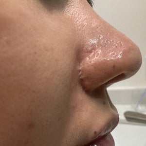 Scar revision post surgery - what would be the best options? (Photo)