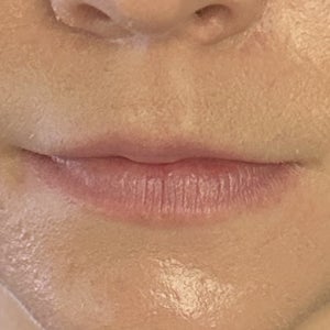 Would lip filler achieve a natural and more symmetrical look photos