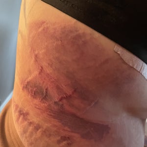 Lipo Burn