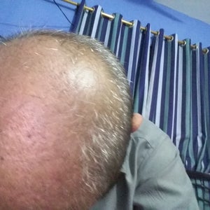 8 weeks after FUE Hair transplant, worried about the transplanted hair,  does it look okay? (photos)
