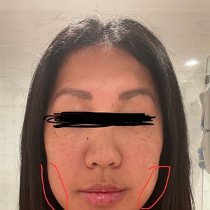 Sculptra totally transformed her face - RealSelf