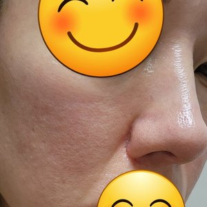 Rhinoplasty revision and scar. What can I do to improve this? (Photo)