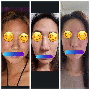 Rhinoplasty revision and scar. What can I do to improve this? (Photo)