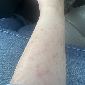 Pubshaving Rash Rash On Legs From Shaving