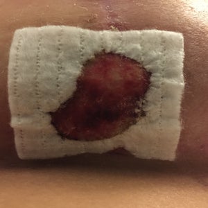 When should I be changing this aquacel dressing? (Photo) When should I be changing this aquacel dressing? (Photo)