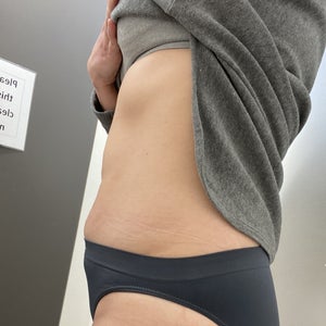 l carnitine post workout Abdominal Liposuction - KleinLipo main image 1