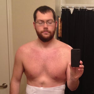 Protruding Xiphoid Process After Tummy Tuck