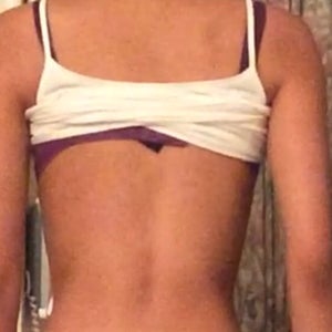 I have narrow hips. Would I be a good candidate for a BBL? (Photo)