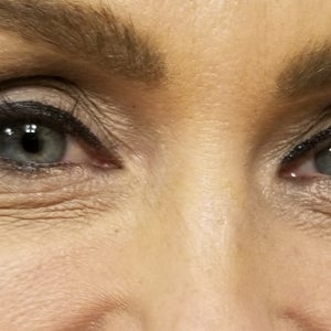 CO2 fillers or Botox for under eye wrinkles when smiling Photo