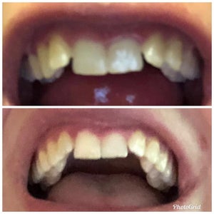 Clear Braces Reviews Was It Worth It Realself