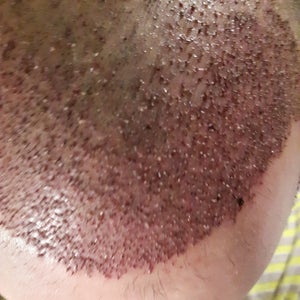 Can I smoke, nicotine free e-cigarette after a FUE? (Photo)