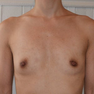 Do I have breast hypoplasia? What can I do to correct this?