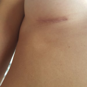 6 Month BOOB JOB UPDATE! (photos, scars, Q&A, etc) 