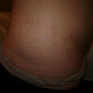 Stretch Marks Treatment Reviews Was It Worth It Realself