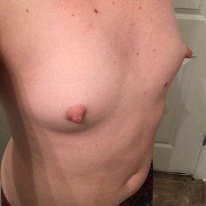 Are my breasts too wide set to ever have any cleavage after breast  augmentation? (photos)