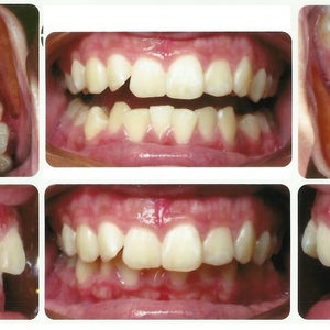 4 Premolar Extractions Worried About Face Tmj Have Had Multiple Opinions 3 Say Extractions 1 Says No Extractions Photos