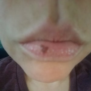 melanotan freckles reddit Can this lip freckle be removed? (Photo)