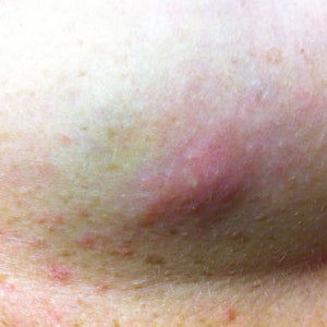 Is a yeast rash a medical reason for insurance to pay for a tummy