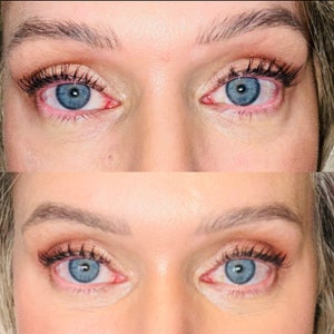 The Denver Eyelid Surgeon - Denver
